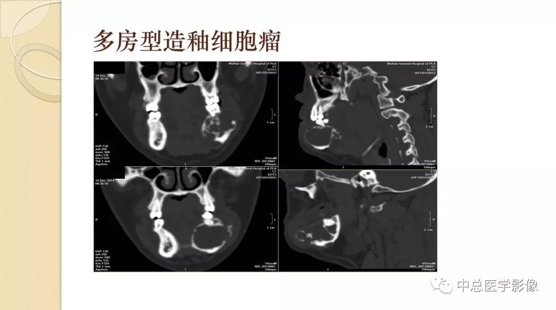 影像PPT - 【PPT】颌骨造釉细胞瘤CT影像表现-12