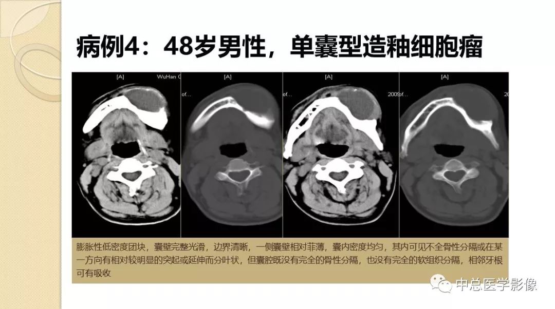 影像PPT - 【PPT】颌骨造釉细胞瘤CT影像表现-13