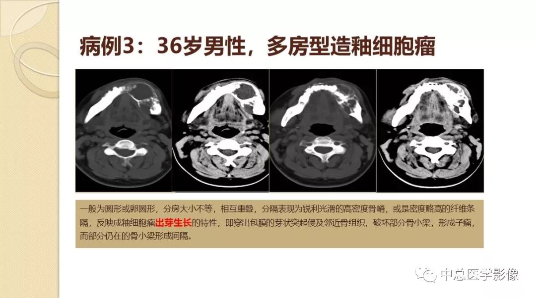 影像PPT - 【PPT】颌骨造釉细胞瘤CT影像表现-11