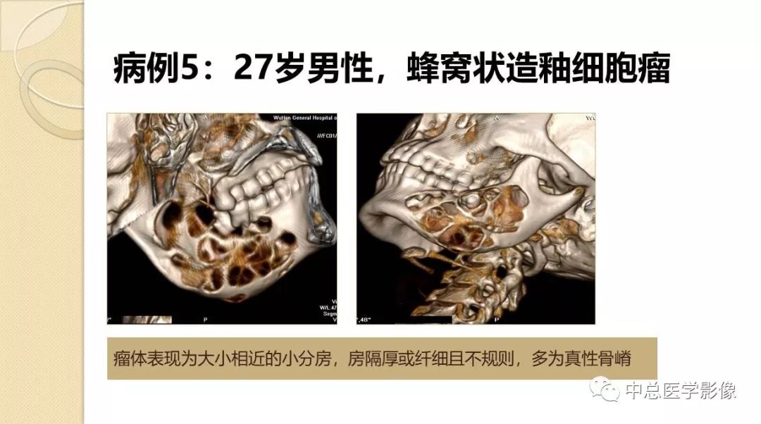 影像PPT - 【PPT】颌骨造釉细胞瘤CT影像表现-15