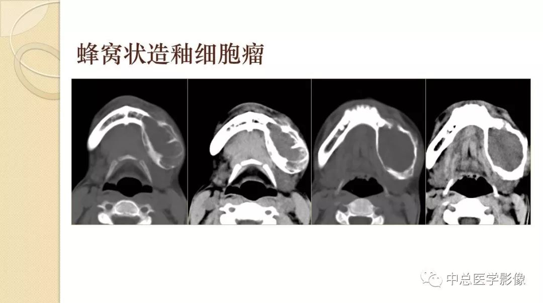 影像PPT - 【PPT】颌骨造釉细胞瘤CT影像表现-16