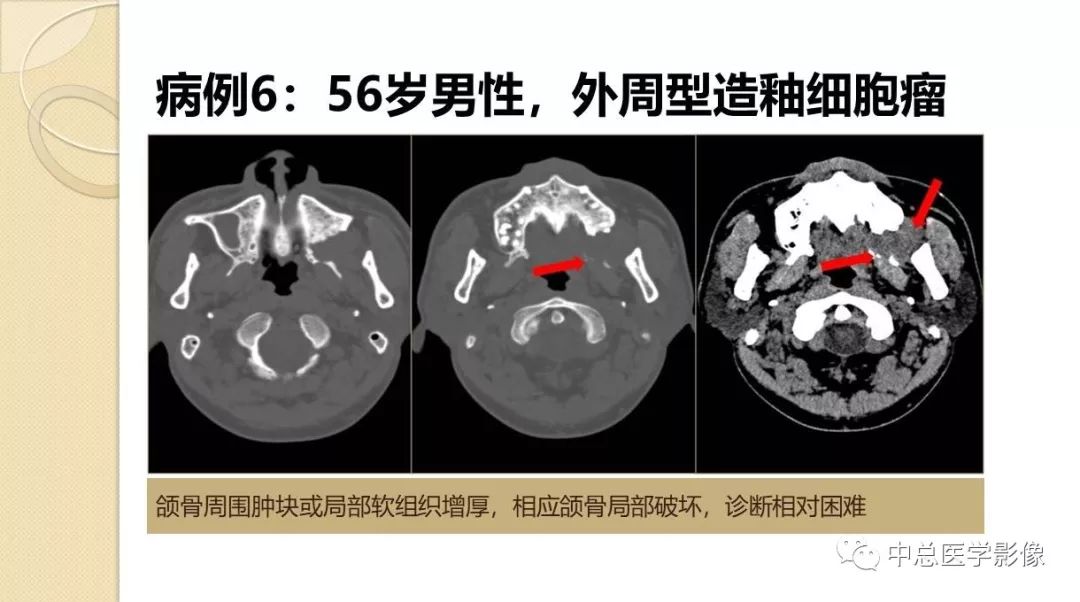 影像PPT - 【PPT】颌骨造釉细胞瘤CT影像表现-17