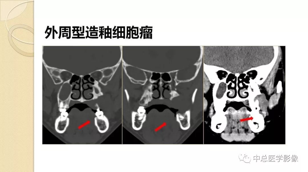 影像PPT - 【PPT】颌骨造釉细胞瘤CT影像表现-18