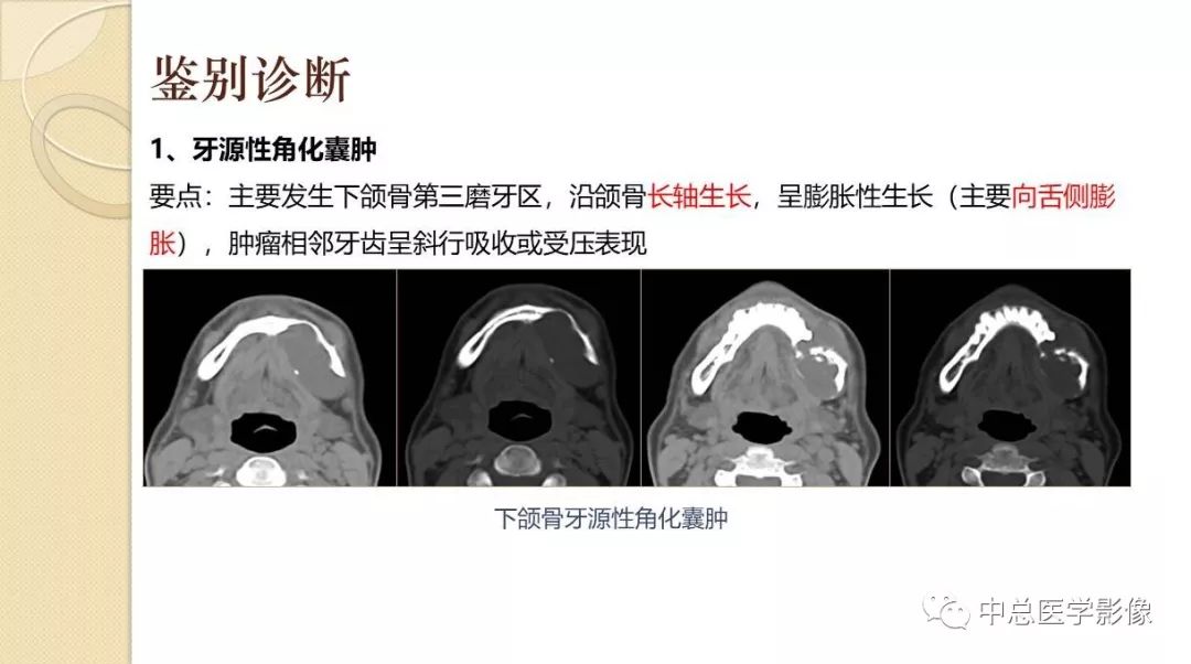 影像PPT - 【PPT】颌骨造釉细胞瘤CT影像表现-21