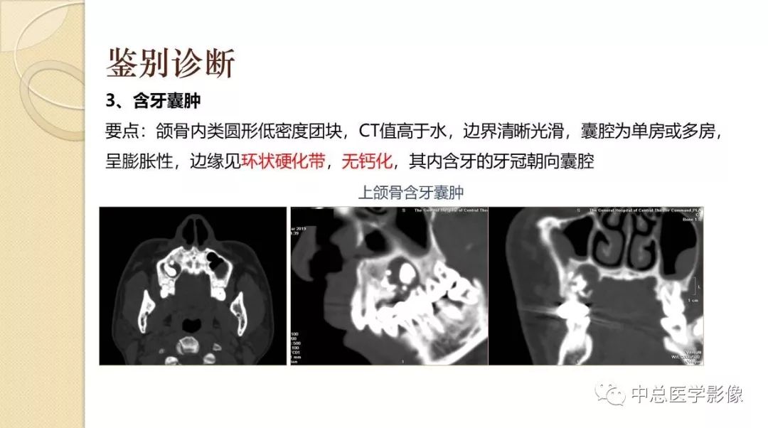 影像PPT - 【PPT】颌骨造釉细胞瘤CT影像表现-25