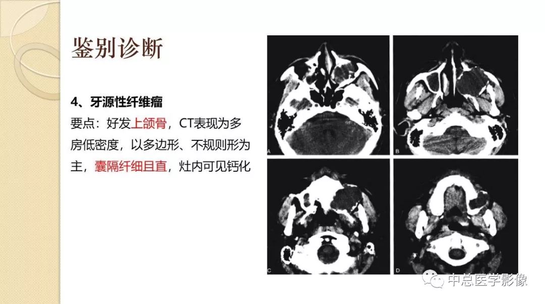 影像PPT - 【PPT】颌骨造釉细胞瘤CT影像表现-26
