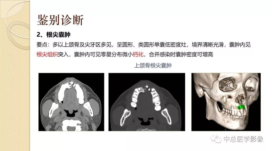 影像PPT - 【PPT】颌骨造釉细胞瘤CT影像表现-24