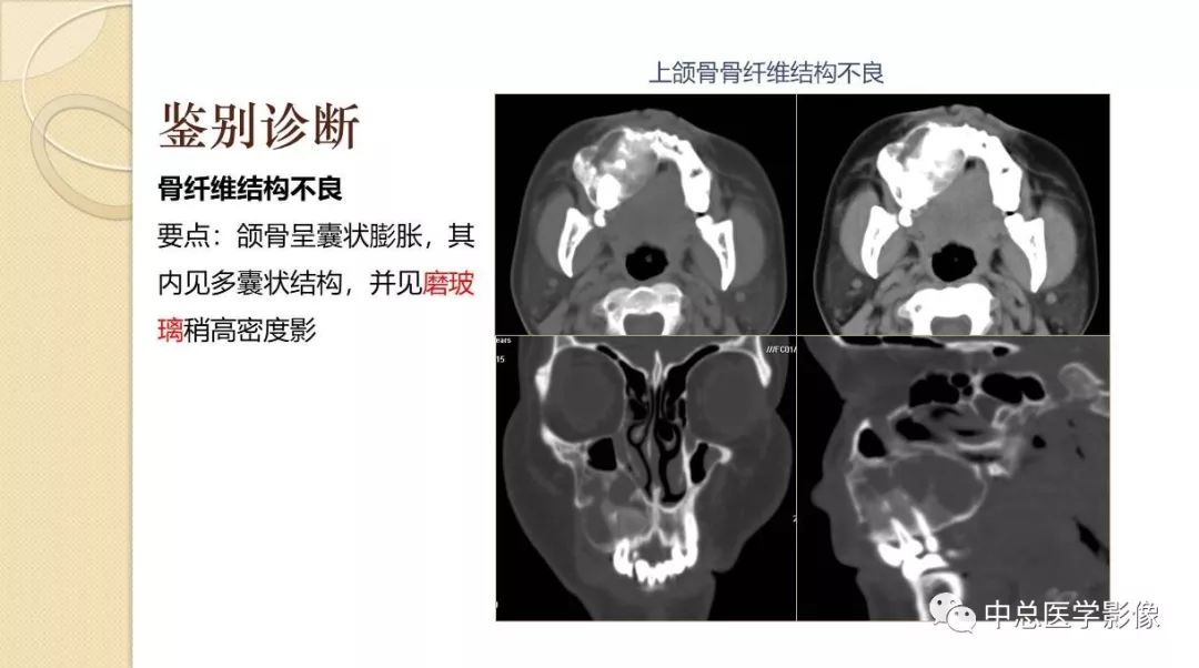 影像PPT - 【PPT】颌骨造釉细胞瘤CT影像表现-28