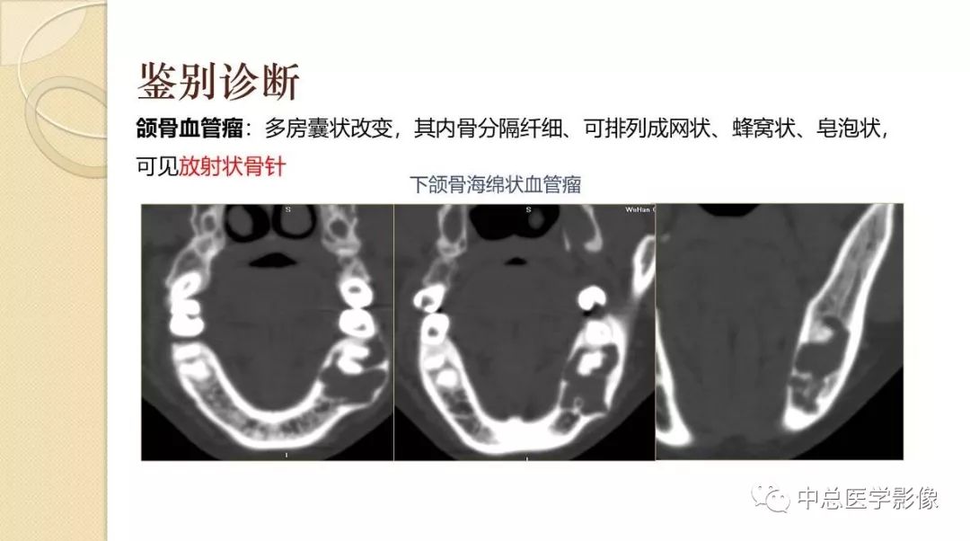 影像PPT - 【PPT】颌骨造釉细胞瘤CT影像表现-27