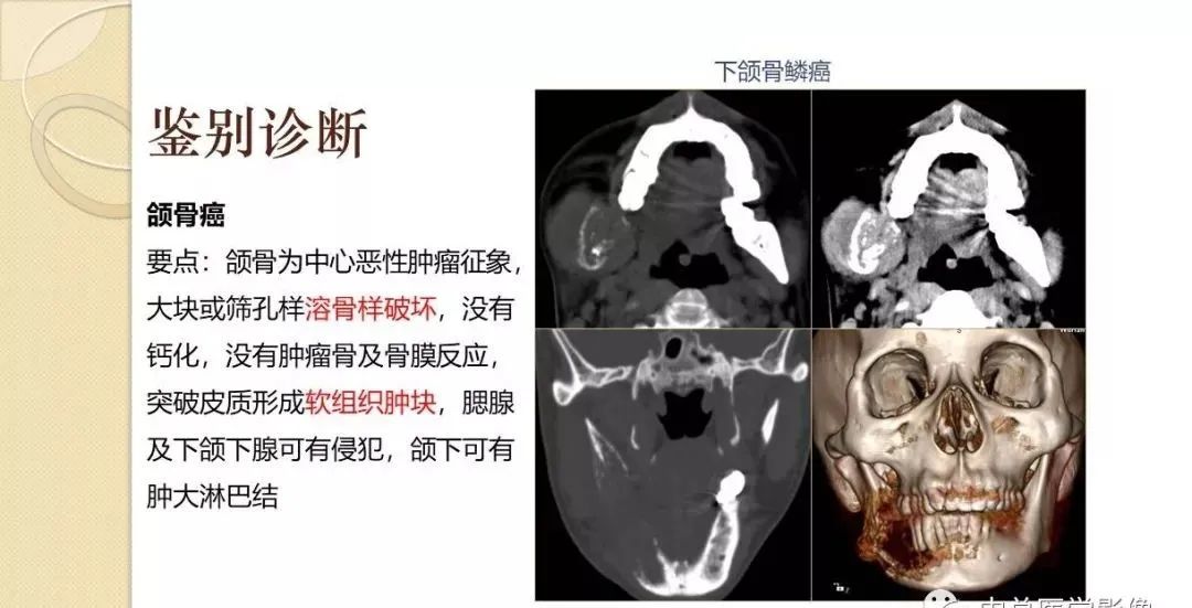 影像PPT - 【PPT】颌骨造釉细胞瘤CT影像表现-29