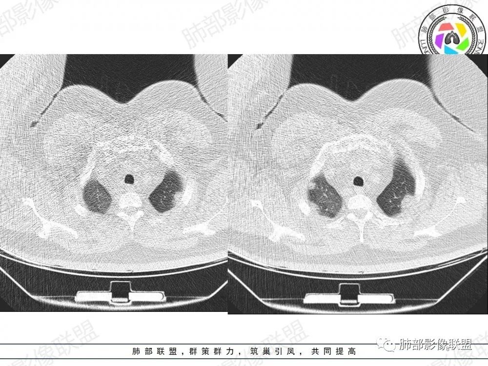 影像PPT - 【病例】透过影像识病毒—病毒性肺炎4例影像-3