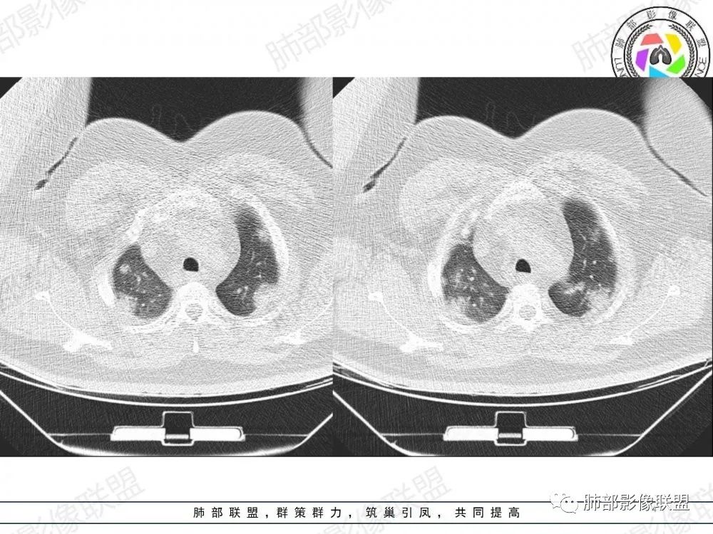 影像PPT - 【病例】透过影像识病毒—病毒性肺炎4例影像-4