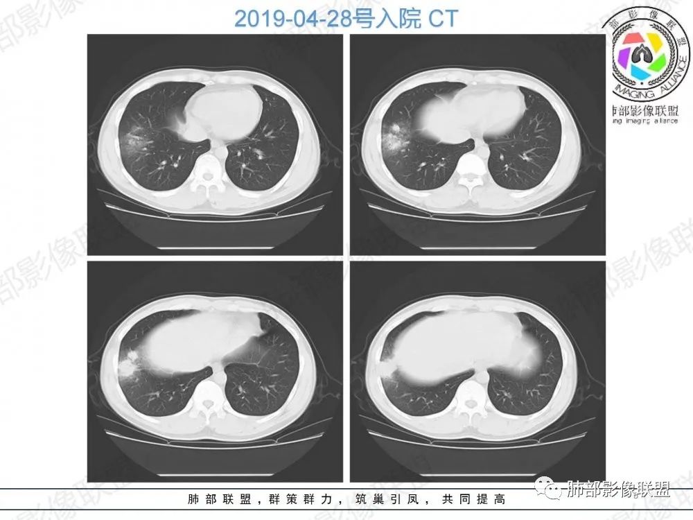 影像PPT - 【病例】透过影像识病毒—病毒性肺炎4例影像-44