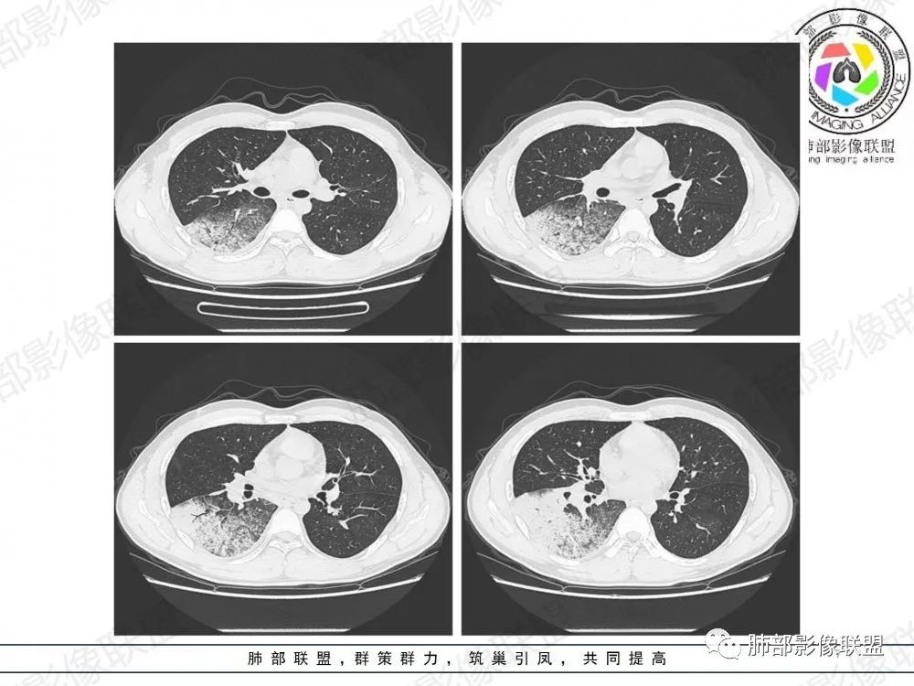 影像PPT - 【病例】透过影像识病毒—病毒性肺炎4例影像-46