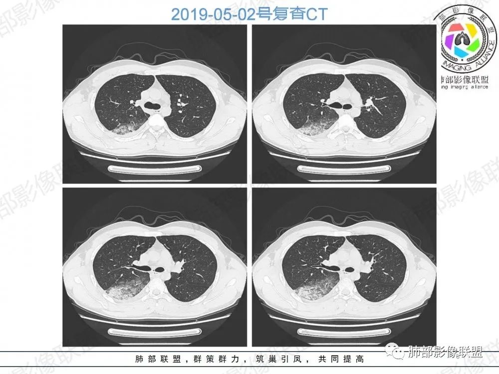 影像PPT - 【病例】透过影像识病毒—病毒性肺炎4例影像-45