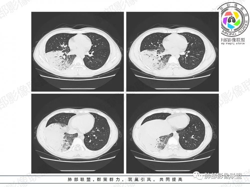 影像PPT - 【病例】透过影像识病毒—病毒性肺炎4例影像-47