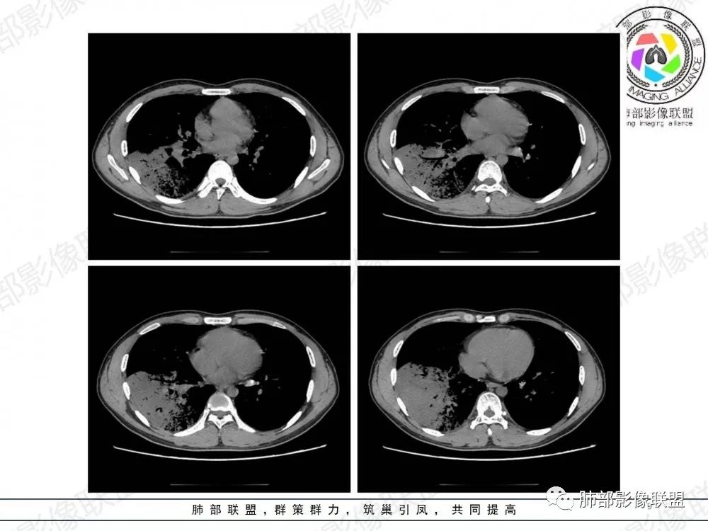 影像PPT - 【病例】透过影像识病毒—病毒性肺炎4例影像-48
