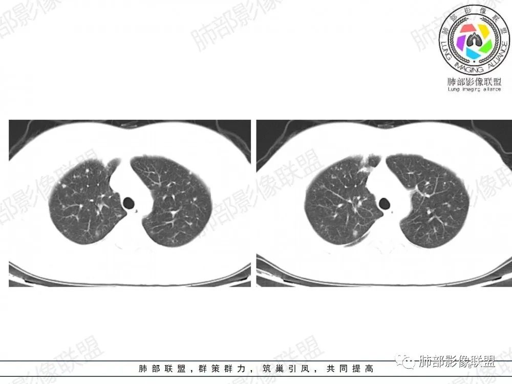 影像PPT - 【病例】透过影像识病毒—病毒性肺炎4例影像-54