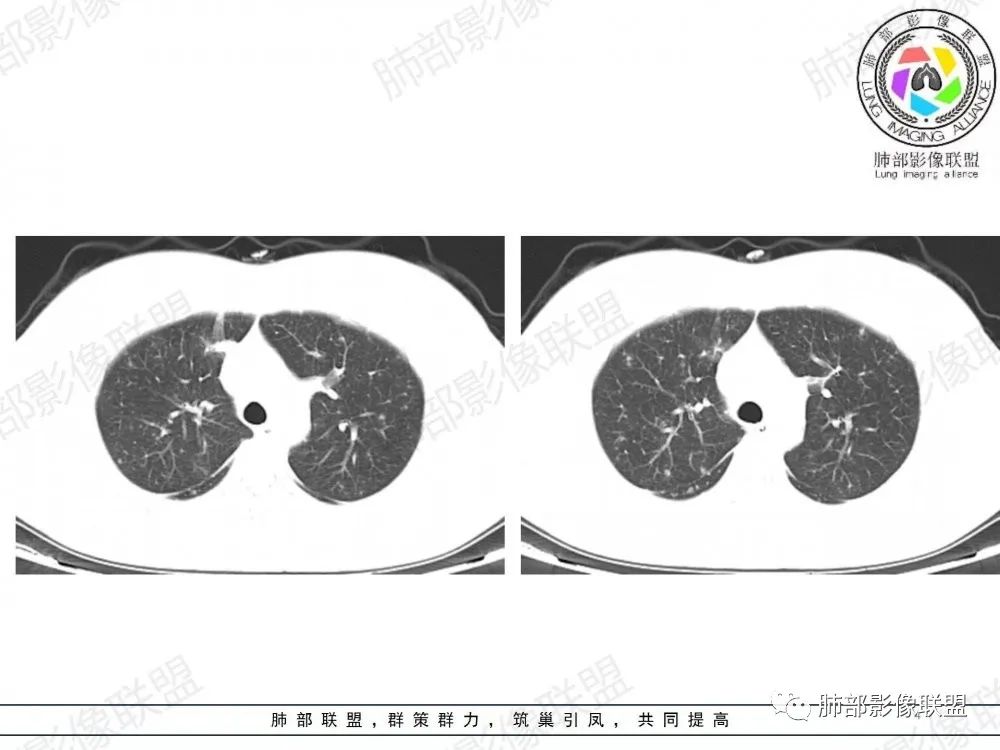影像PPT - 【病例】透过影像识病毒—病毒性肺炎4例影像-55
