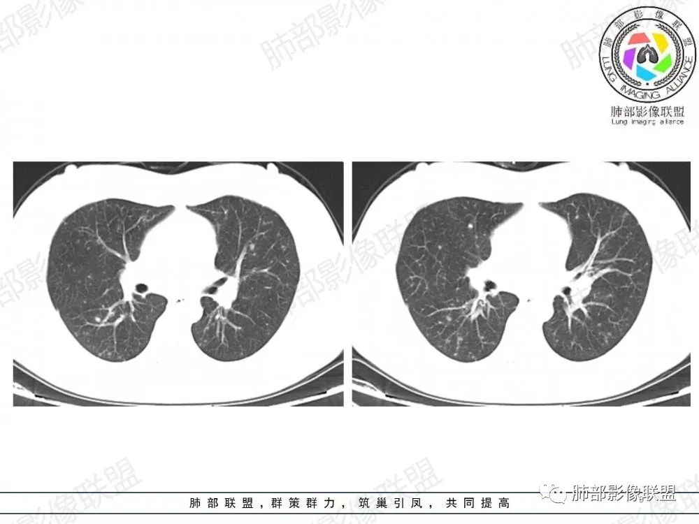 影像PPT - 【病例】透过影像识病毒—病毒性肺炎4例影像-60