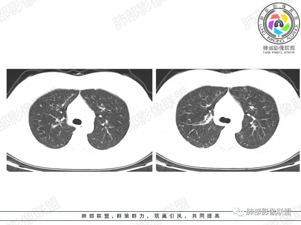 影像PPT - 【病例】透过影像识病毒—病毒性肺炎4例影像-56