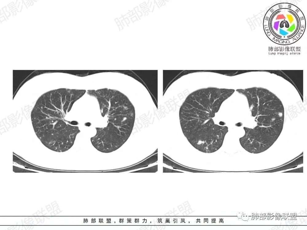 影像PPT - 【病例】透过影像识病毒—病毒性肺炎4例影像-58