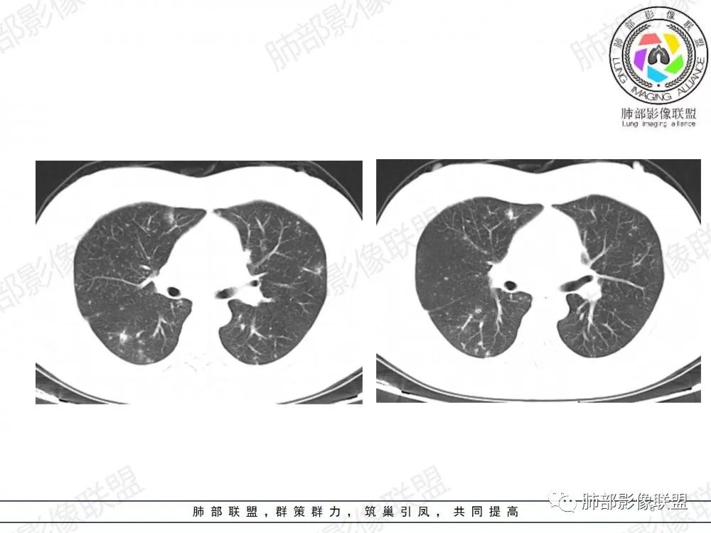 影像PPT - 【病例】透过影像识病毒—病毒性肺炎4例影像-59