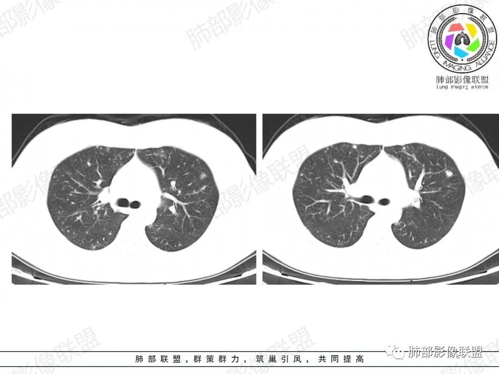 影像PPT - 【病例】透过影像识病毒—病毒性肺炎4例影像-57