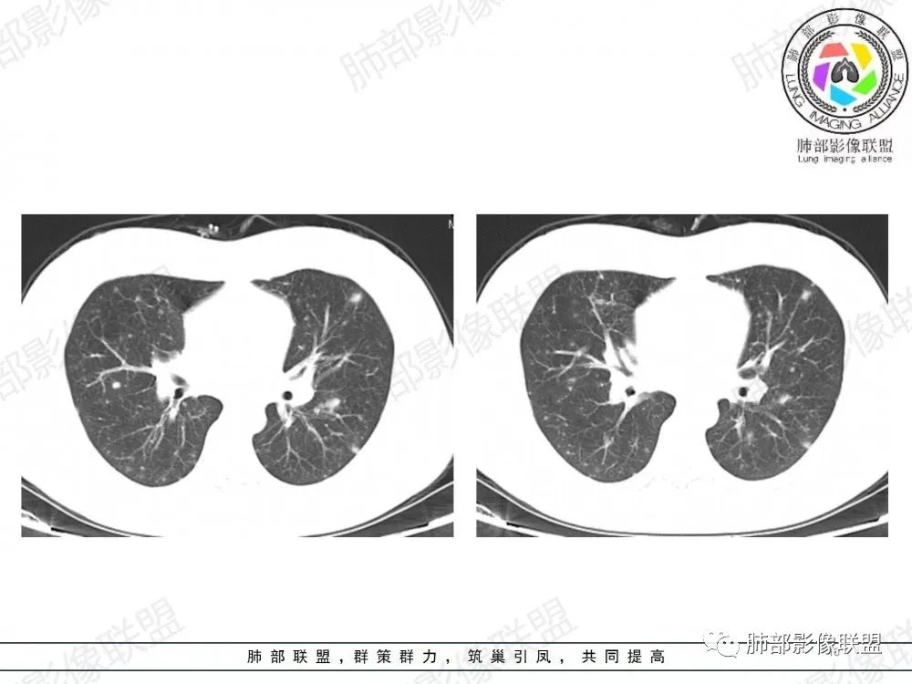 影像PPT - 【病例】透过影像识病毒—病毒性肺炎4例影像-61