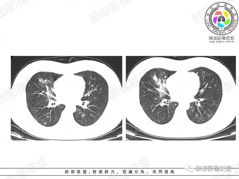 影像PPT - 【病例】透过影像识病毒—病毒性肺炎4例影像-62