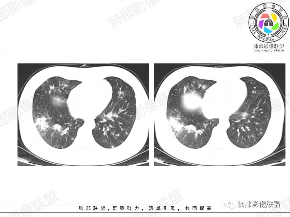 影像PPT - 【病例】透过影像识病毒—病毒性肺炎4例影像-66