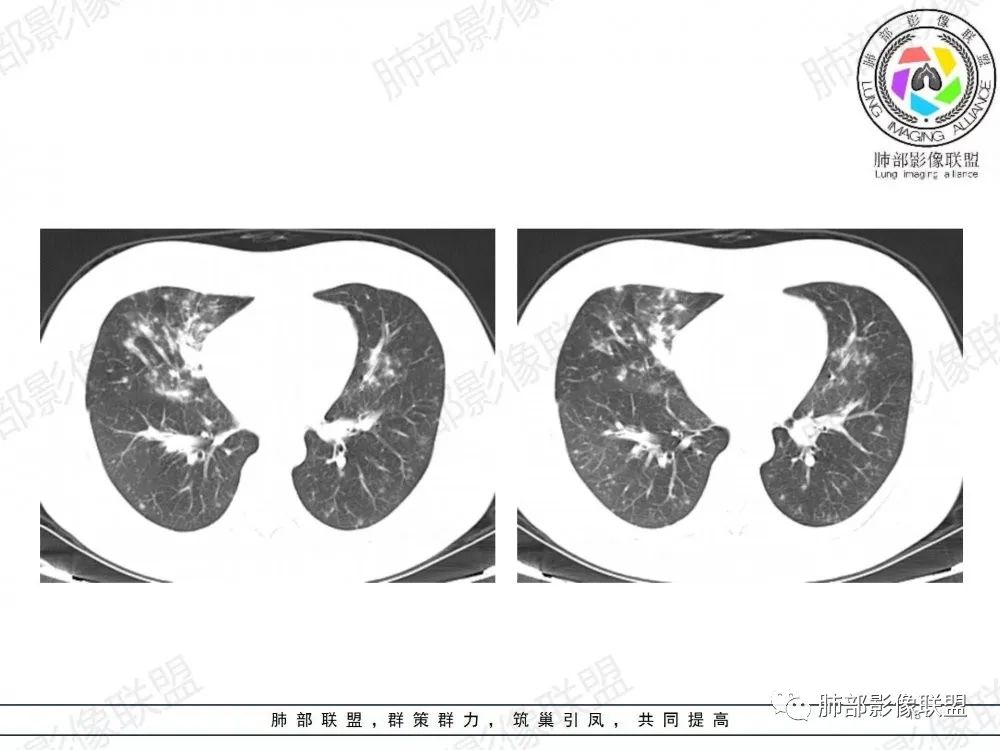 影像PPT - 【病例】透过影像识病毒—病毒性肺炎4例影像-64