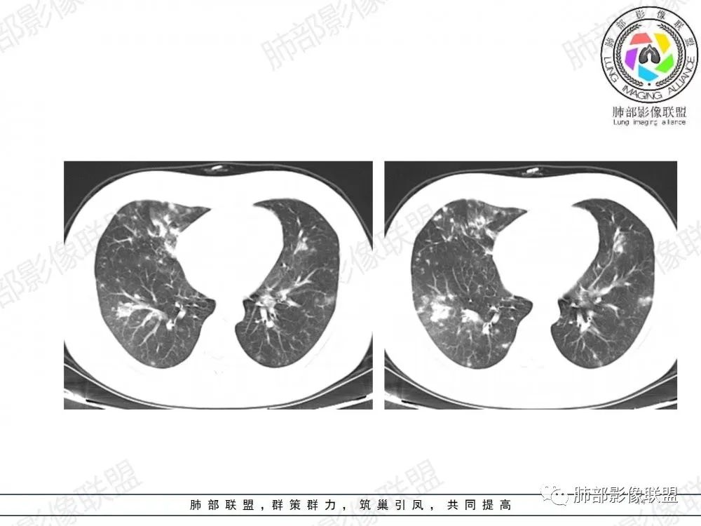 影像PPT - 【病例】透过影像识病毒—病毒性肺炎4例影像-65