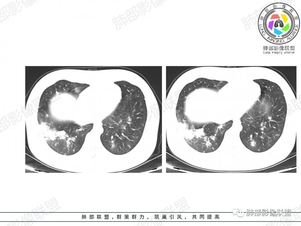 影像PPT - 【病例】透过影像识病毒—病毒性肺炎4例影像-67
