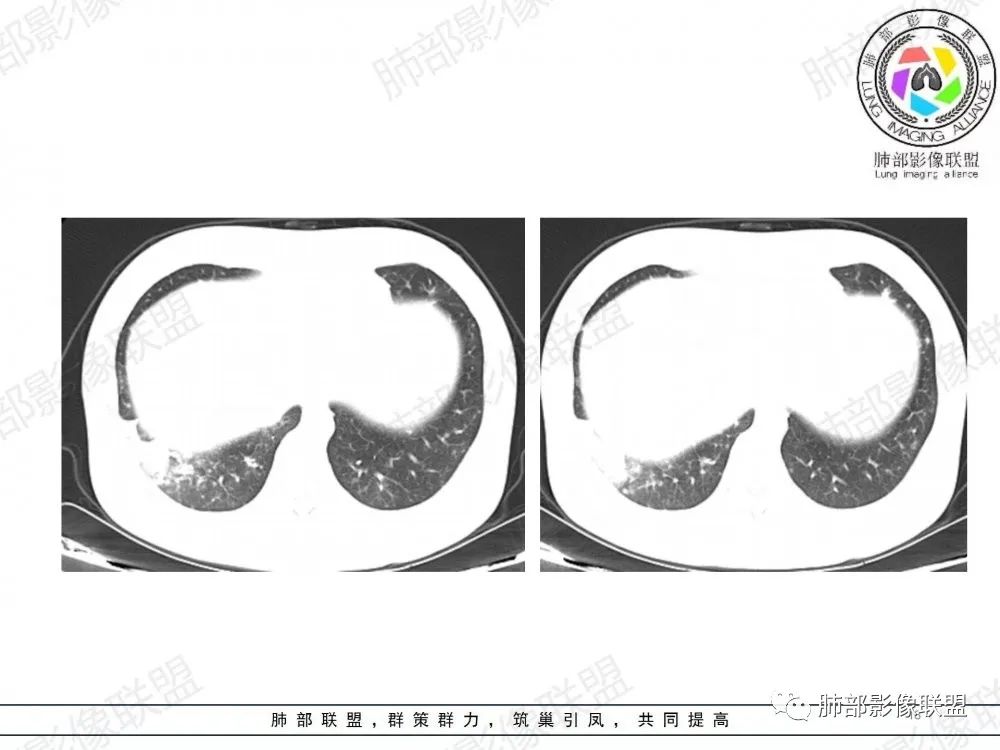 影像PPT - 【病例】透过影像识病毒—病毒性肺炎4例影像-69