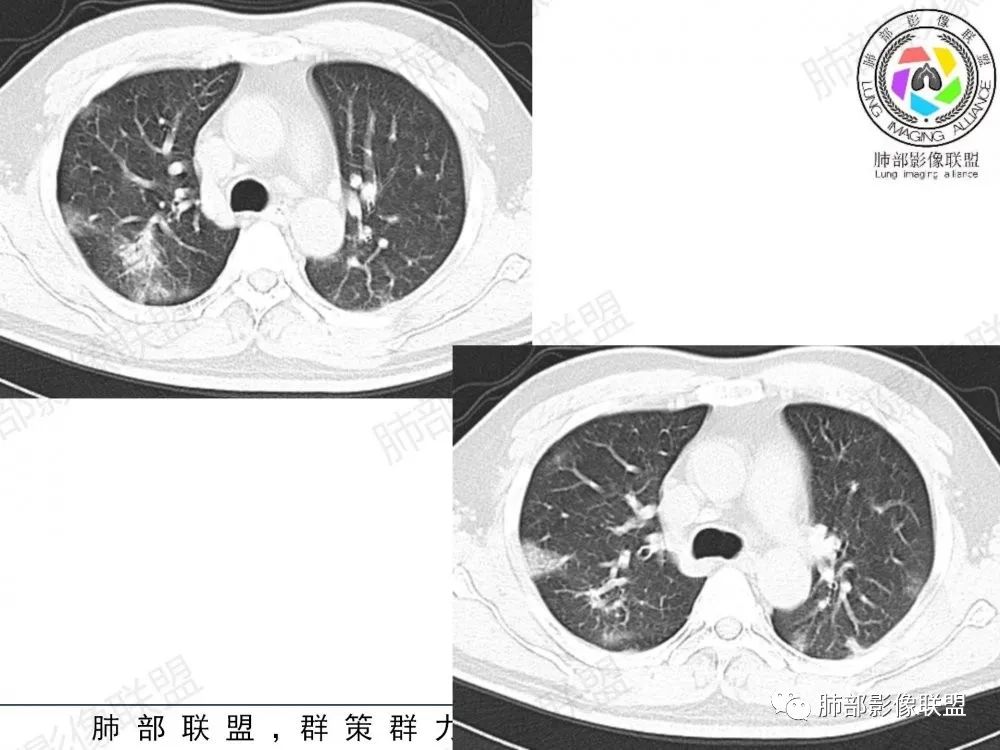 影像PPT - 【病例】透过影像识病毒—病毒性肺炎4例影像-72