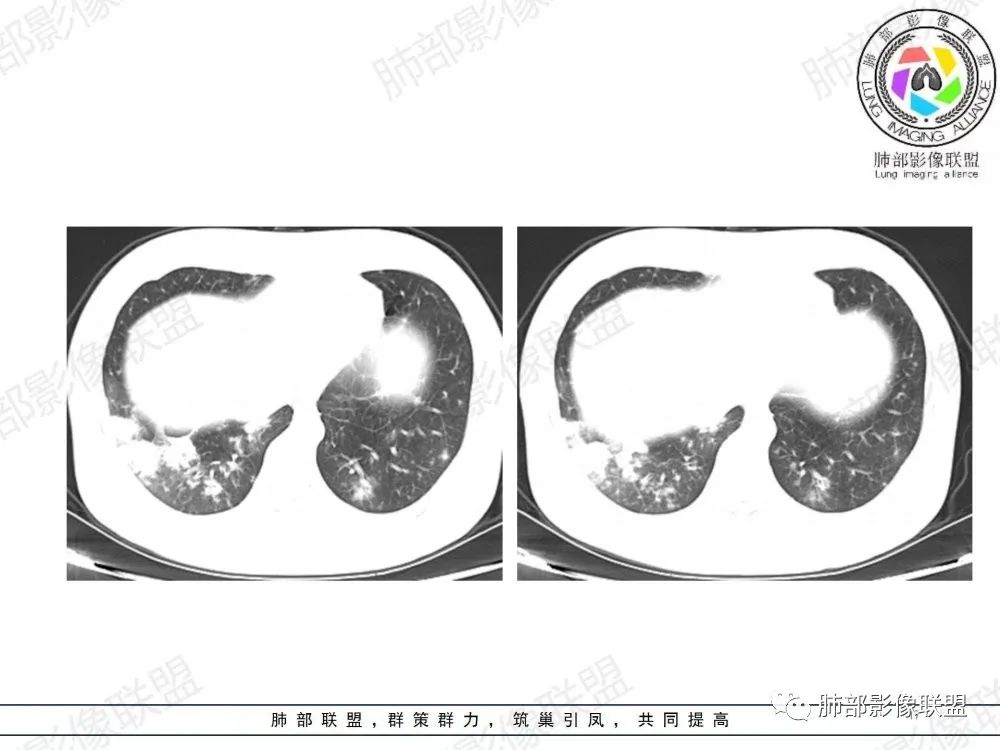 影像PPT - 【病例】透过影像识病毒—病毒性肺炎4例影像-68
