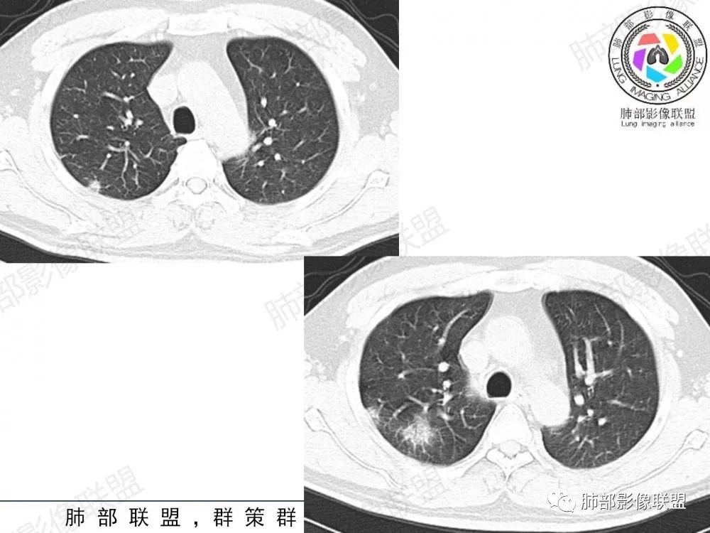 影像PPT - 【病例】透过影像识病毒—病毒性肺炎4例影像-71