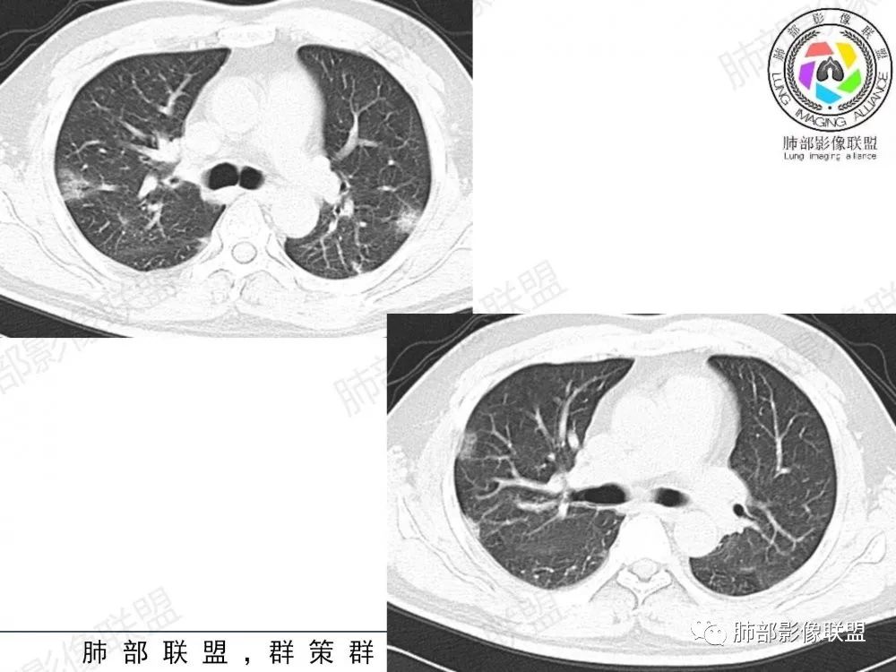 影像PPT - 【病例】透过影像识病毒—病毒性肺炎4例影像-73