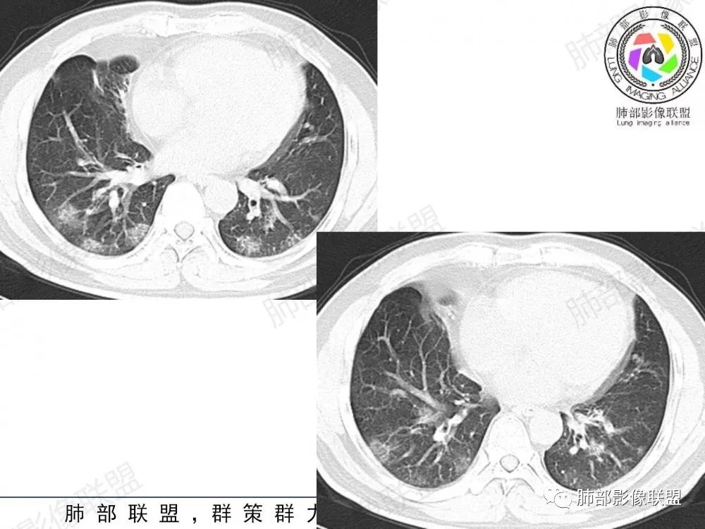 影像PPT - 【病例】透过影像识病毒—病毒性肺炎4例影像-77