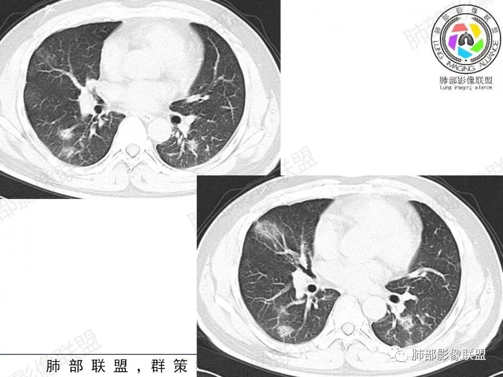 影像PPT - 【病例】透过影像识病毒—病毒性肺炎4例影像-75