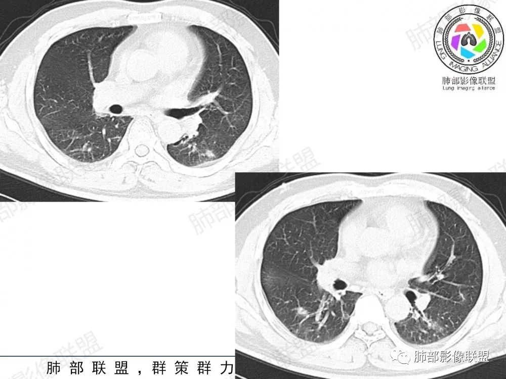 影像PPT - 【病例】透过影像识病毒—病毒性肺炎4例影像-74