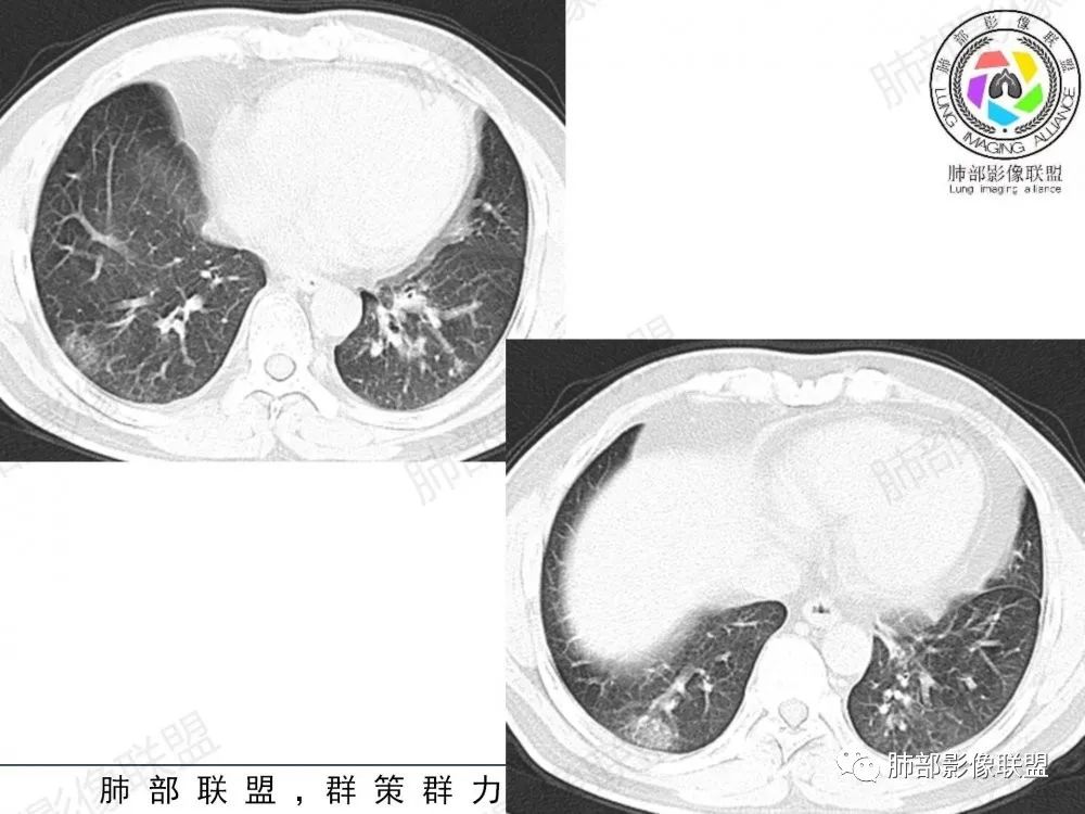影像PPT - 【病例】透过影像识病毒—病毒性肺炎4例影像-78
