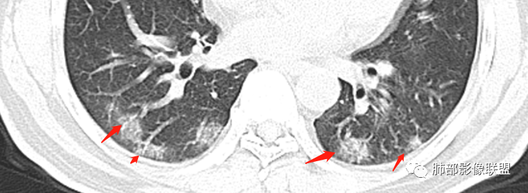 影像PPT - 【病例】透过影像识病毒—病毒性肺炎4例影像-82
