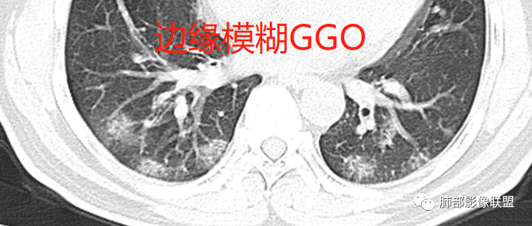 影像PPT - 【病例】透过影像识病毒—病毒性肺炎4例影像-83