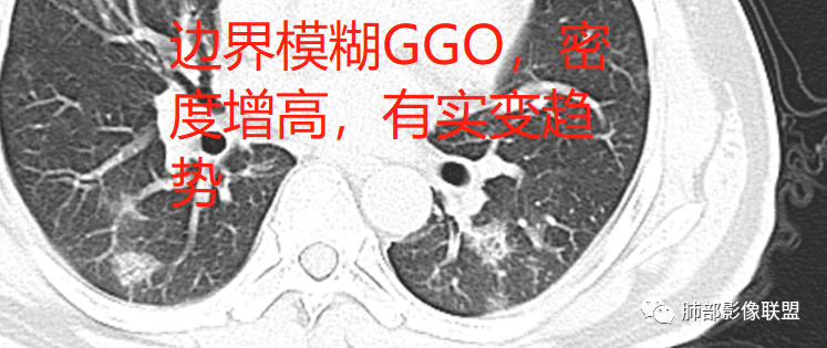 影像PPT - 【病例】透过影像识病毒—病毒性肺炎4例影像-84