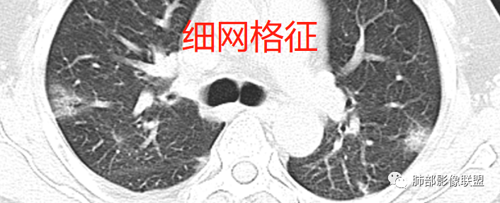 影像PPT - 【病例】透过影像识病毒—病毒性肺炎4例影像-87