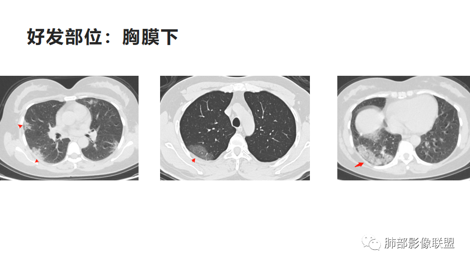 影像PPT - 【病例】透过影像识病毒—病毒性肺炎4例影像-91
