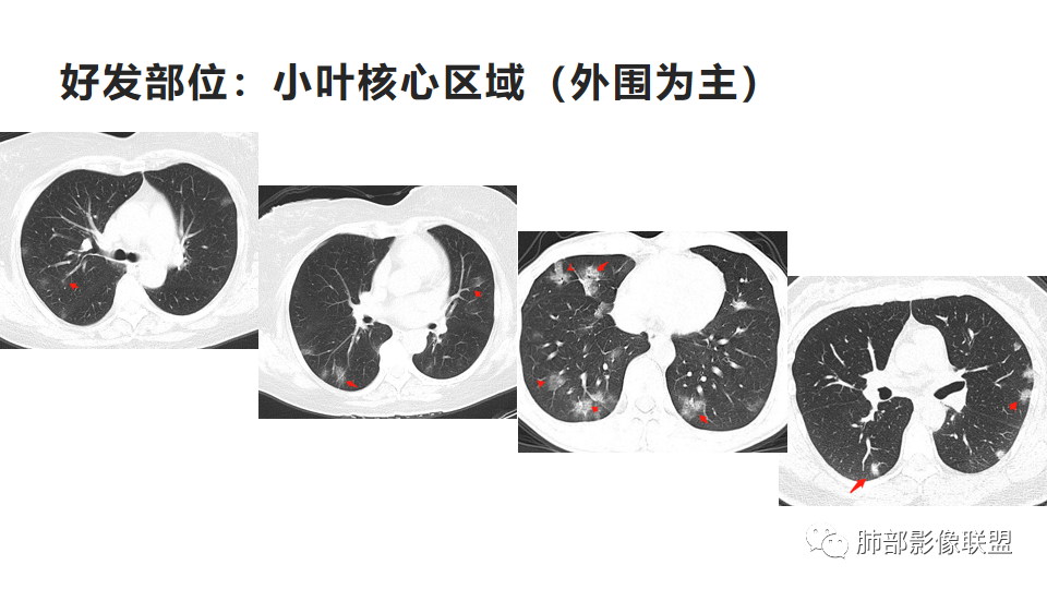 影像PPT - 【病例】透过影像识病毒—病毒性肺炎4例影像-90
