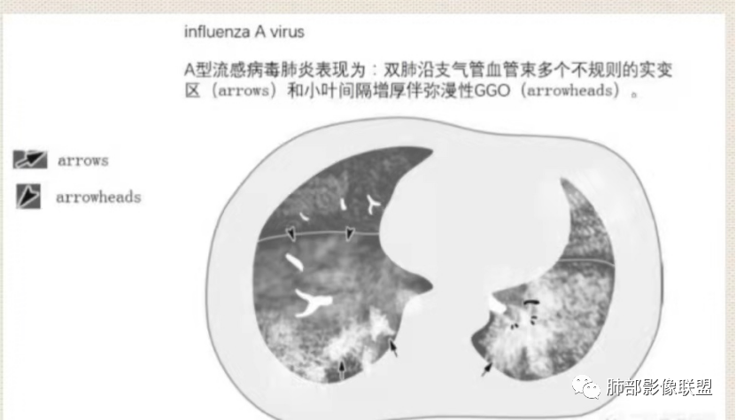 影像PPT - 【病例】透过影像识病毒—病毒性肺炎4例影像-94